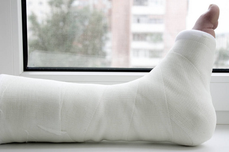 打着石膏的腿图片