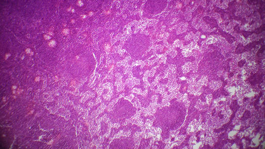 脖子淋巴结肿大图片