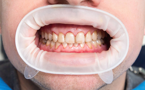 氟斑牙的特写照片