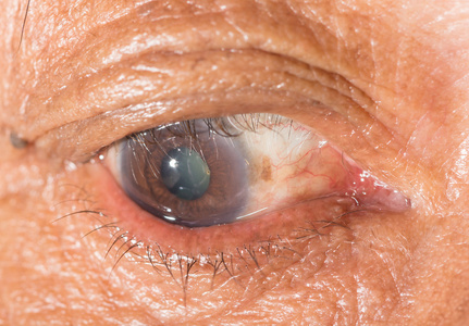 沙眼衣原体图片