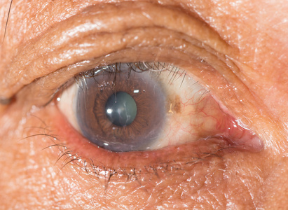 沙眼衣原体图片