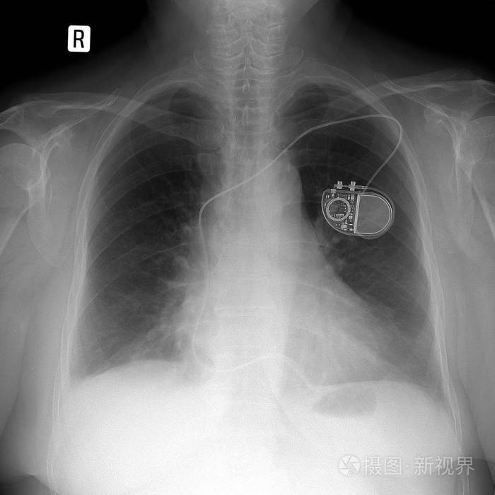 X 射线肺。在左边的心脏起搏器