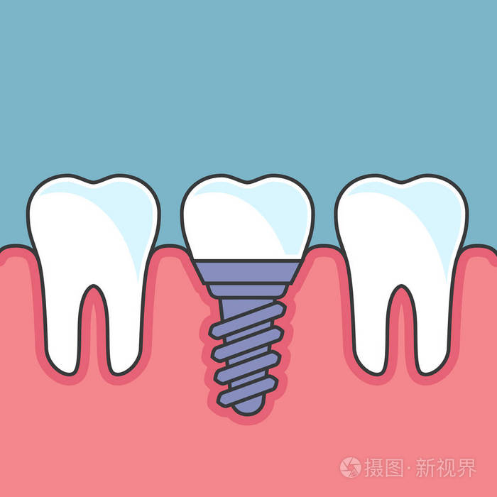 排牙与牙种植体-口腔修复