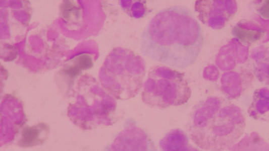 异常血细胞背景