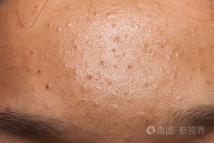 一名少年的额头粉刺黑头