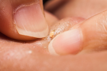用指甲挤压青少年鼻子上的粉刺照片