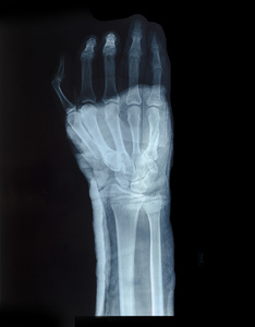 X 射线图像的人的手