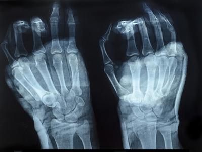 人类的手的 x 射线图像