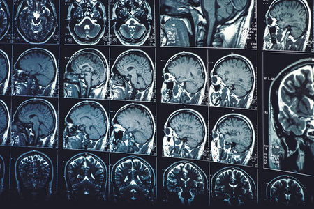 头颅或颅内磁共振成像或磁共振成像及脑扫描