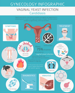 酵母感染。念珠菌病。Ginecological医疗疾病图表。矢量插图