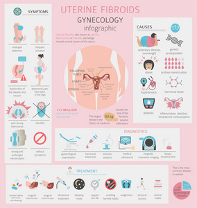 子宫肌瘤。Ginecological 妇女图表的医疗疾病。矢量插图