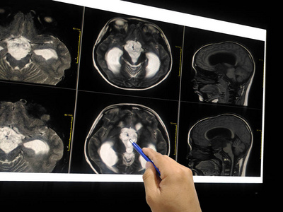 在液晶显示器上显示肿块或肿瘤的病人的 mri 脑部的手部医生