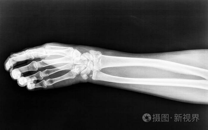 骨折的半径出生的权利妇女的手臂移位 我们看到在x 射线照片 正版商用图片0oa6dx 摄图新视界
