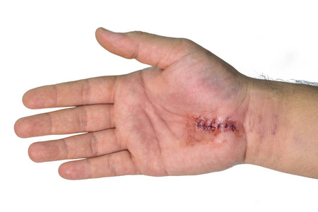 腕管综合征图片