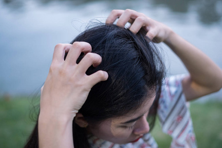 女性头上有头皮屑造成的肮脏问题。或皮肤疾病或脂溢性皮炎引起的。它有白色鳞片, 它会引起瘙痒