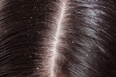 关于女人的黑头发头皮屑照片