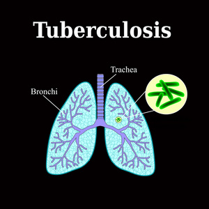 结核病。肺部疾病。结核菌。在黑色背景上的矢量图