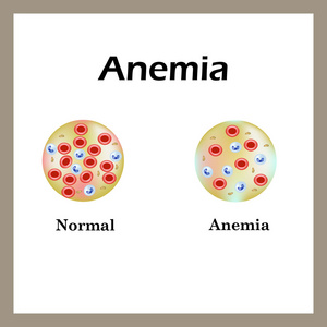 贫血。红血减少的数额。信息图表。矢量图