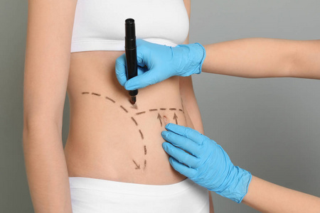 美容外科手术用女性腹部的医生画痕, 特写