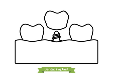 牙科植入物卡通矢量轮廓样式