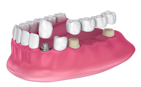 牙支承固定桥, 植入物和冠。医学上精确的3d 例证
