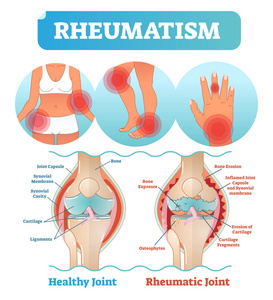 风湿病医疗保健向量插图海报图与损伤的膝糜烂和痛苦的身体关节