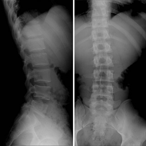 X 射线的腰骶部脊柱，额叶矢视图脊柱侧凸
