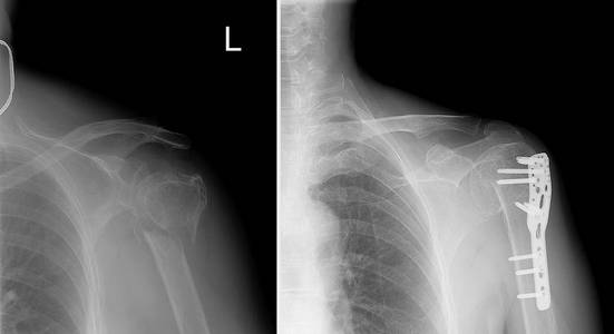 X 射线图像的左肩，显示颈部骨折，随后由金属结构前投影