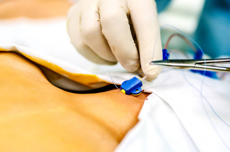 通过缝纫修复中心导管由麻醉师的过程