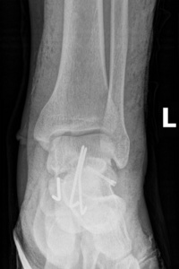 X 射线与装入医疗螺丝和钉子的脚