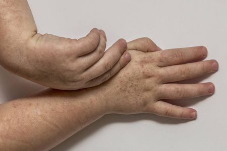 猩红热.两个孩子手里有传染性的红色小皮疹.白色背景照片