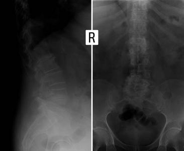X 射线变形颈椎病的腰椎，Antelisthesis