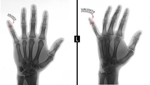 X 射线的手。显示左手小指末节的半脱位。标记。负面