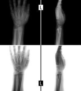 X 射线的手。显示骨膜下桡骨骨折的左的孩子。积极。负面