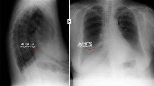 X 射线肺。显示右肺体积形成。标记
