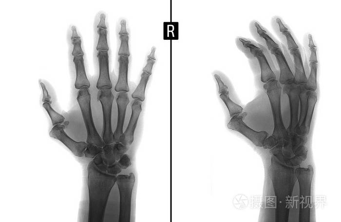 x射线的手显示右手食指指骨关节的半脱位负面