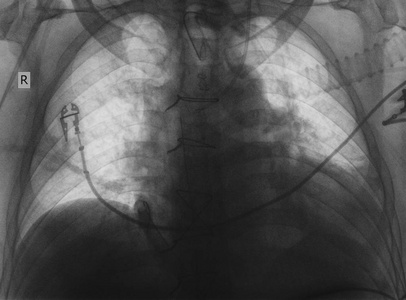 心脏手术后病人的 x 线检查