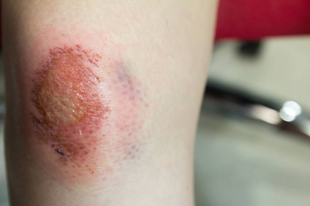 新鲜的伤口与淋巴和血液对亚洲女性膝盖背景
