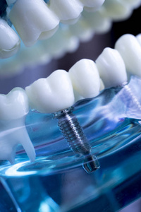 牙科牙医牙科教学模型显示钛金属牙植入螺钉