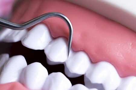 牙科医生用钛金属剔牙清洗牙齿以去除斑块和腐烂