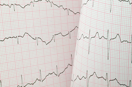 心电图测试结果照片