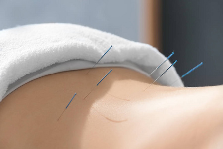针灸治疗图片