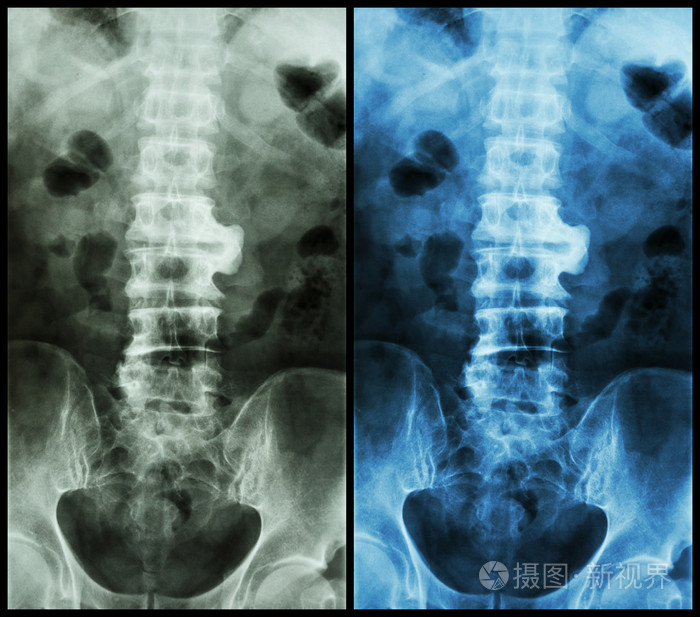 脊椎病x片x线骶椎显示脊椎病