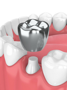 牙科冠汞齐充填3d 齿