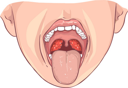 扁桃腺炎图片 扁桃腺炎素材 扁桃腺炎插画 摄图新视界 扁桃腺炎图片 扁桃腺炎素材 扁桃腺炎插画 摄图新视界