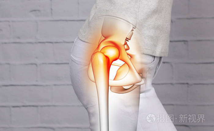 患髋关节疼痛的妇女