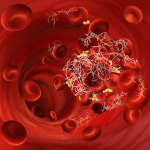 血凝块血栓或栓子的向量例证与凝固的红细胞, 血小板在身体的血管