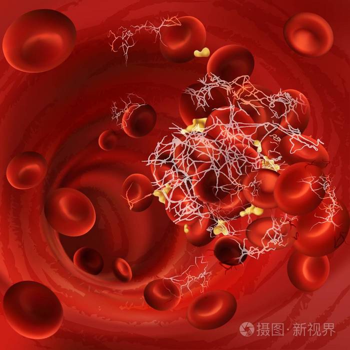 血凝块血栓或栓子的向量例证与凝固的红细胞血小板在身体的血管