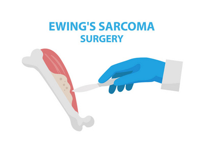 在平面设计中, 在白色背景下分离出的尤文氏肉瘤手术矢量图。外科手术切除肿瘤的医学图表因素
