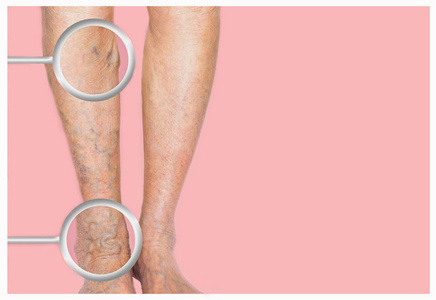 在女性的腿上静脉曲张照片